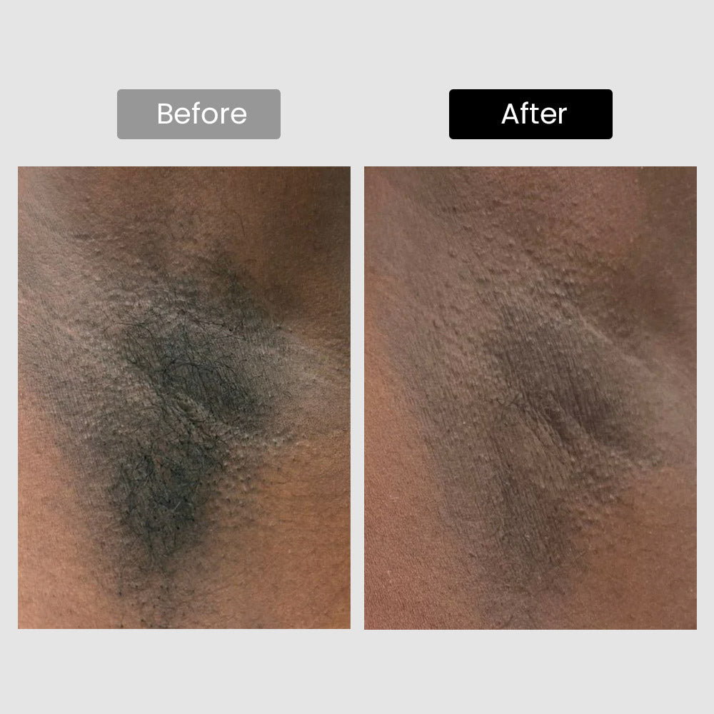 DermRays V6S Diode Laser Hair Removal, 1064nm, Specifically For Dark Skin