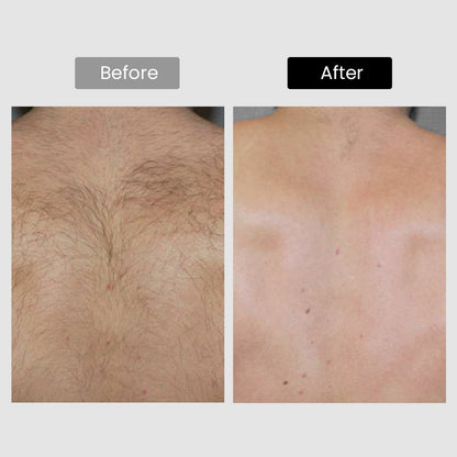 DermRays V8S *Enhanced Edition* Diode Laser Hair Removal, Pro-level cooling, Target Thick Hair with Precision