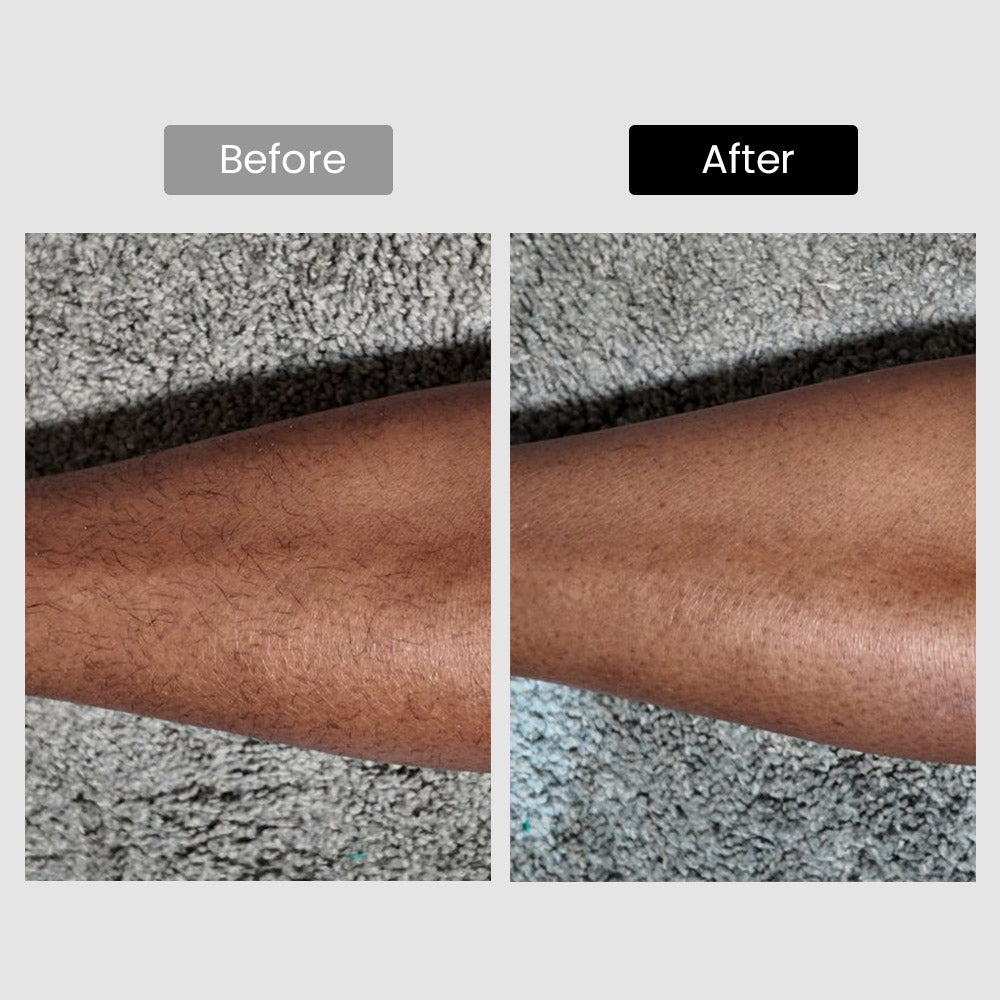 DermRays V6S Diode Laser Hair Removal, 1064nm, Specifically For Dark Skin