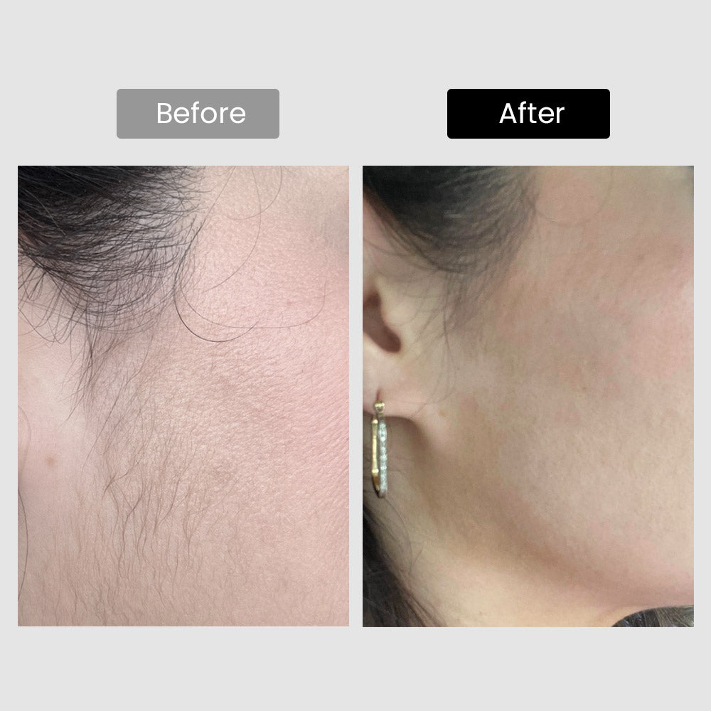 DermRays V8S Diode Laser Hair Removal, 810nm, Faster Results, Most Powerful