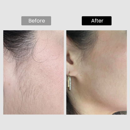 DermRays V8S Diode Laser Hair Removal, 810nm, Faster Results, Most Powerful